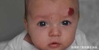 太田母斑|以为宝宝的前额是胎记,但是医生诊断后妈妈后傻眼了