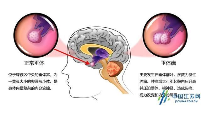  竟是|男子突发头痛失明 竟是凶险的垂体瘤卒中