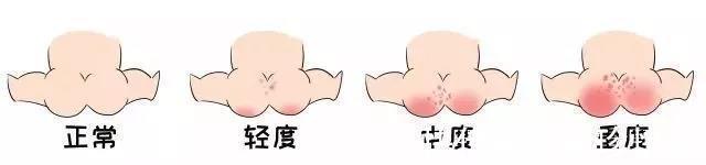 腹泻|秋季腹泻来临,“红屁屁”找上门别再用湿巾和爽身粉了,会加重