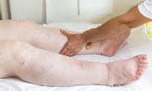 疾病|人老”腿“先衰，腿部会出现4个信号，或是疾病“报到”，莫忽视