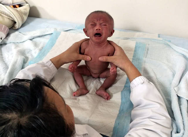 姚甜甜|早产双胞胎姐妹遭遇罕见病,出生时不足两斤,腿还没爸爸手指粗