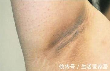 腋窝|胃癌刚发生时,腋窝最先有“异常”,可惜多数人视而不见