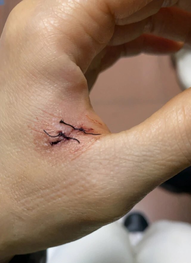 容祖儿太敬业了!带伤上舞台演出,没有任何怨言