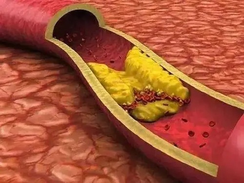 摄入量|84岁大爷斑块消失，他把血管变“干净”的2个方法，其实很科学