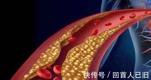 梓醇|中风的“罪魁祸首”是血栓, 记牢两个字血栓不上身