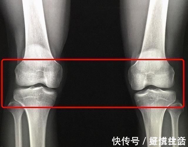 骨骺线|14岁男孩身高153,检查后医生:骨骺线已闭合,最多还能长2-3㎝