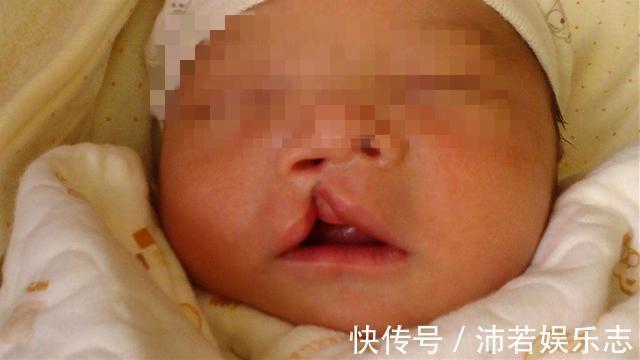 兔唇|产妇生下''兔唇宝宝'',谎称孕期吃了兔肉,医生说破后婆婆很生气