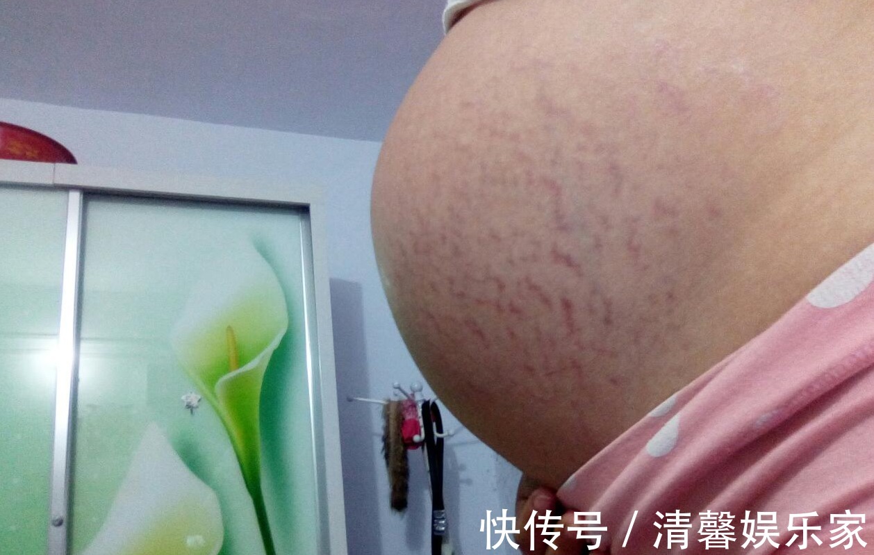 肚皮|孕期妊娠纹“找上门”,体重控好锻炼不能少,坚持守住三原则