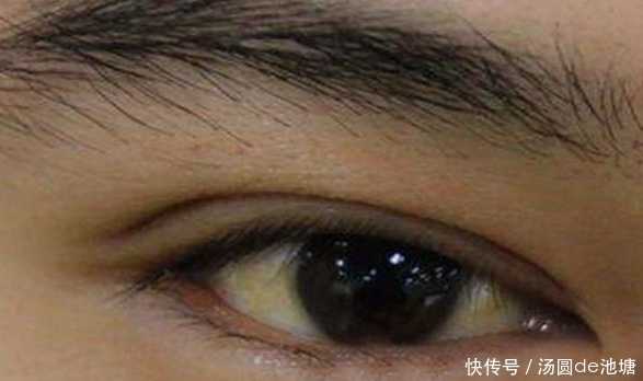 肝解毒能力下降,脸上有“呼救”,若出现,提