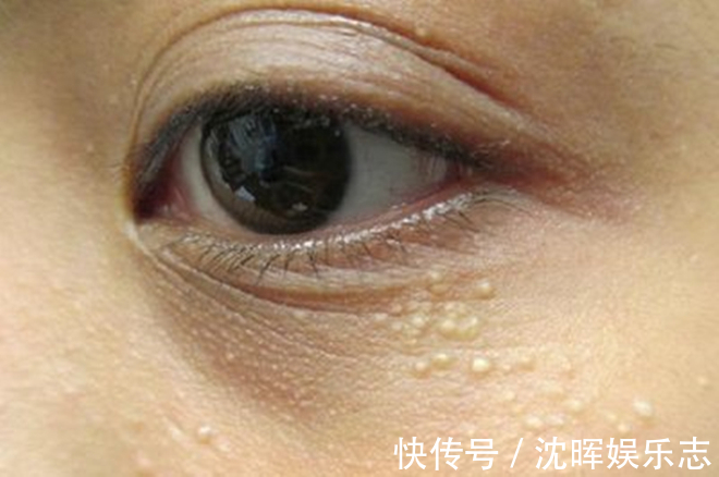 眼角|眼角的脂肪粒怎么消除教你2招,不用针挑也不用手抠,轻松消除