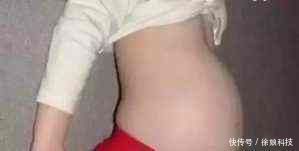 双胞胎|4岁小女孩肚子大的好像孕妇一样,经检查后父母痛心不已