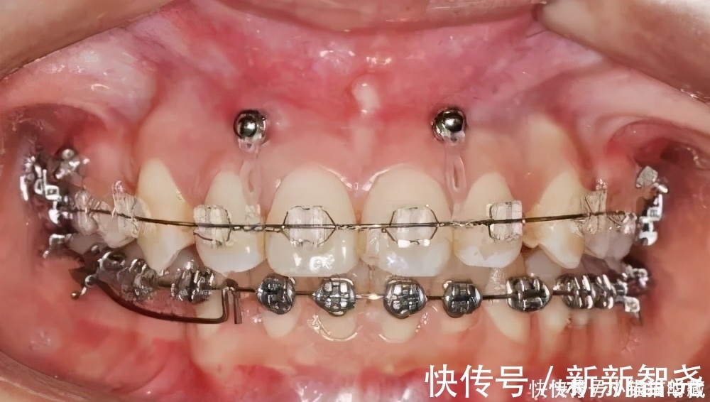 牙槽骨|牙齿矫正一般是什么时候打骨钉?矫正是不是必须打骨钉?