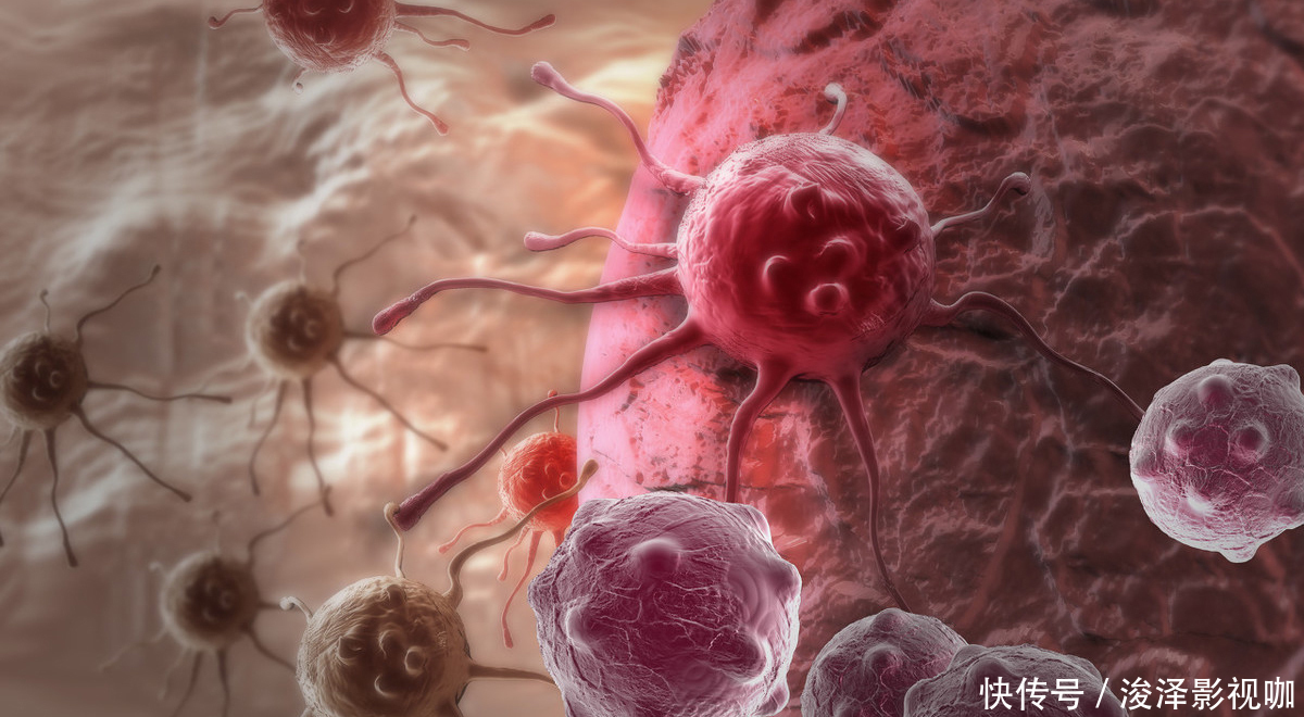 肠癌|得癌症就活不久了？有些肿瘤通过治疗已可接近根治，心态一定要好