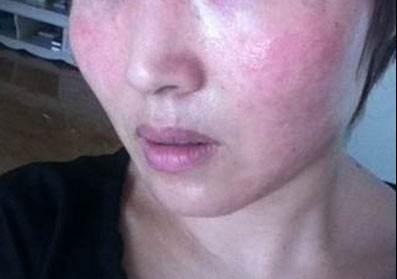 皮肤过敏|皮肤都很脆弱,过敏说来就来,远离它注意以下几点!