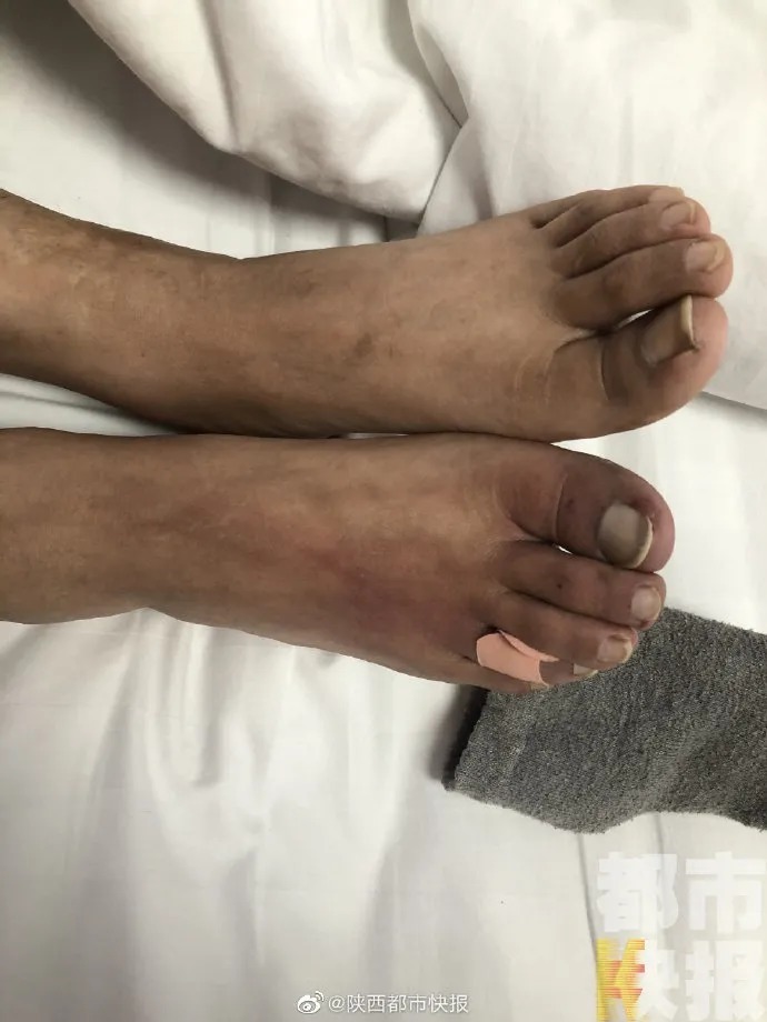疼痛|咋回事?男子双腿突然冰凉疼痛难忍!医生:接近坏死的程度