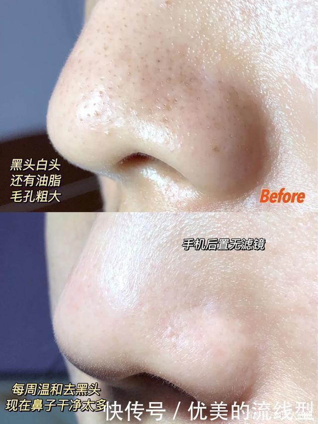 荷荷巴油|这才是去黑头的正确方式,安全有效不伤肤,无暇鸡蛋肌你也能拥有