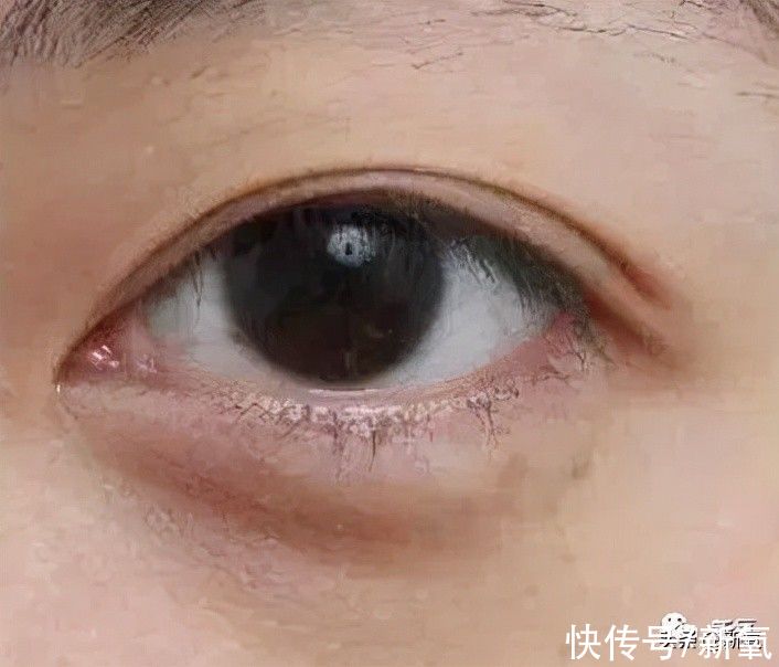 玻尿酸 看了印度选美冠军的素颜，有被熊猫眼惊到