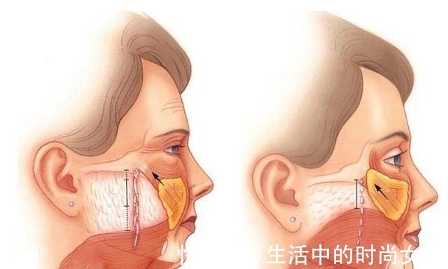 术式 害怕拉皮手术疤痕明显、效果不好她用亲身经历来告诉你如何避免！