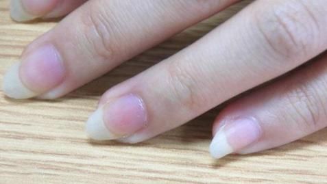 指甲上出现“竖纹”是怎么回事？是好还是坏？