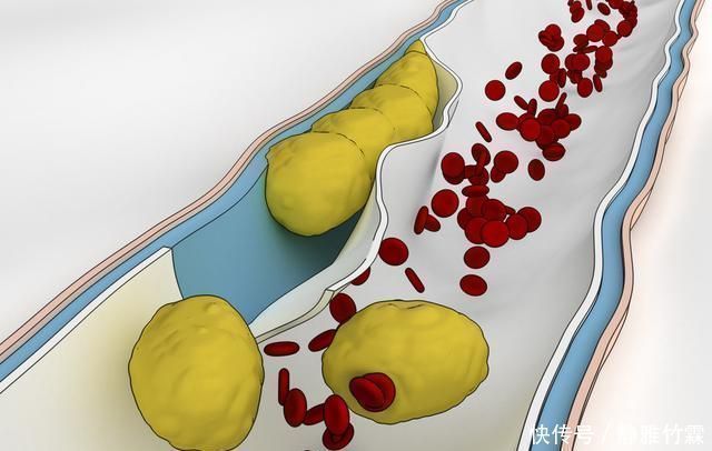 甘油三酯偏高|甘油三酯偏高，喝水时加1物，甘油三酯降到15，血管不堵塞