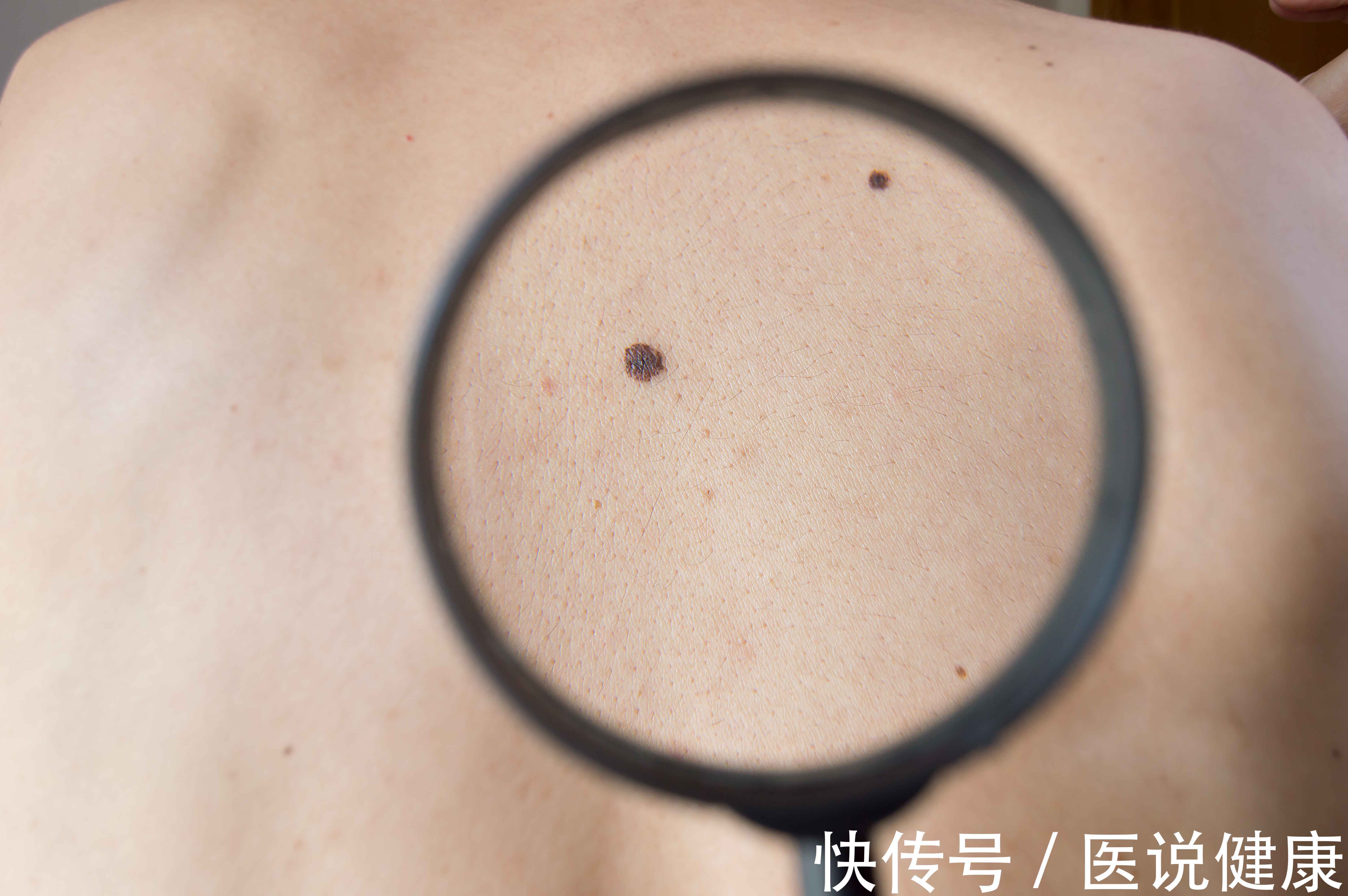 肝硬化|身体出现5种迹象,当心肝硬化或已找上门,要提高警惕