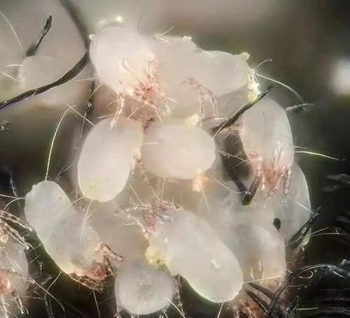 头发上“白泥”增多,或是“它”在作祟,做好4件事,慢慢减少