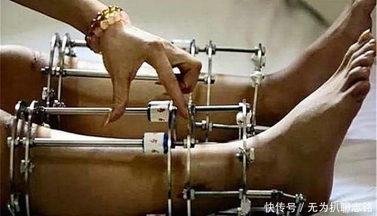 武大郎|为实现长高梦想,花16万断骨增高的李亚诺,如今过得快乐吗