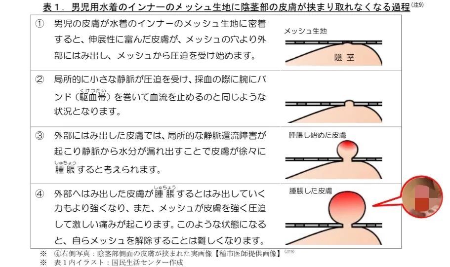 男童|这种泳裤千万别穿 已经有不少小孩的小鸡鸡因它受伤