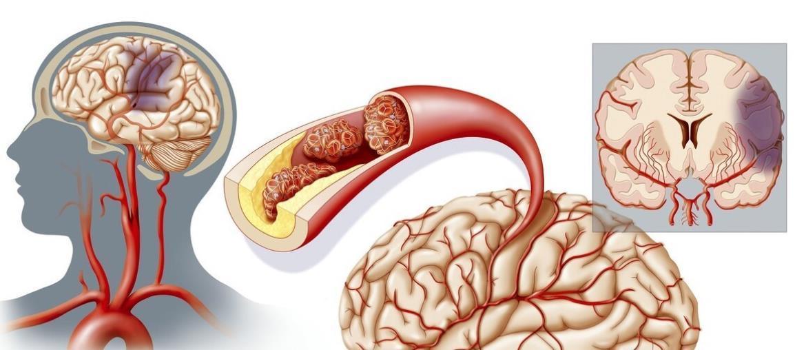心脑血管|为何中国脑梗发病率全球第一？原因：体内缺少叶酸！饮食就能补上