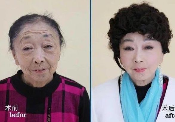 60岁老太婆马玉琴,去医院做拉皮手术,嫁给