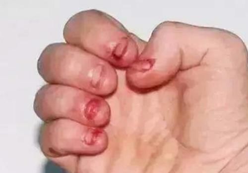 孩子|孩子咬指甲的毛病可能不是缺营养，两种心理诱因，家长需自查