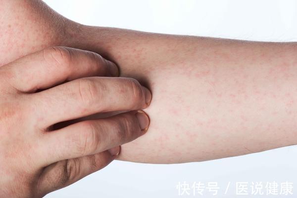 皮肤|皮肤反复出现瘙痒感,要重视,或与这5个因素有关,你需要了解