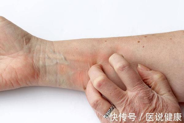 对症治疗|皮肤经常出现瘙痒,可能与这6个因素有关,了解后,需对症治疗