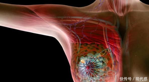 医院|26岁女孩胸部疼痛,医院查出8颗肿瘤,医生:生活心态很重要