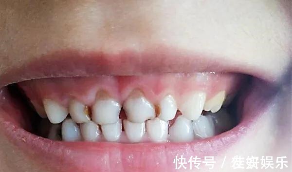 龋齿|4岁男孩牙齿几乎全黑6岁前，不要让孩子自己刷牙！