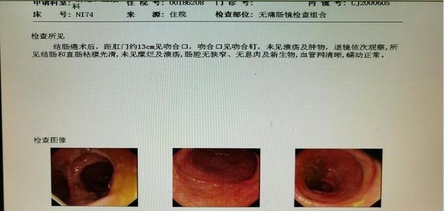 医生|出现便血，是肠癌还是痔疮？医生教你从三方面辨别，别再混淆了