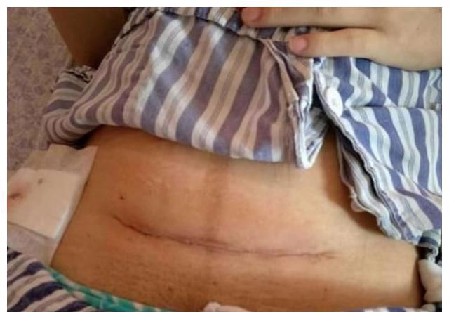 区别|第一次剖腹产和第二次剖腹产,到底有啥区别?疼痛度不同只是基础