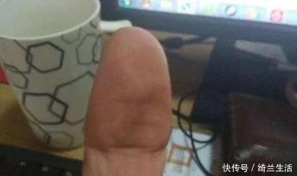 手指肚|大拇指上暗藏的中风信号,一旦出现赶紧就医