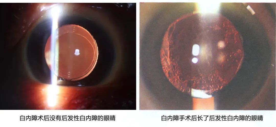 山东中医药大学|白内障手术做了以后又看不清了，难道白挨了刀？！