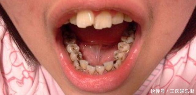 水漱|孩子被嘲笑“嘴太臭”,被同学孤立,医生取出小颗粒,宝妈都嫌臭