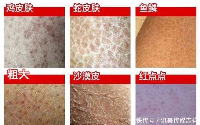 买了裙子，但是鸡皮还没解决！有啥办法缓解鸡皮肤？