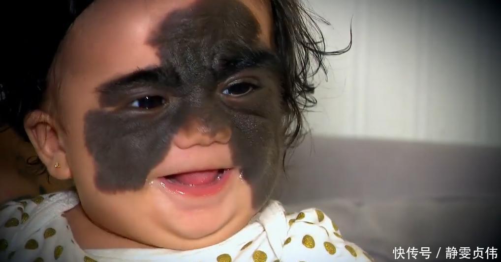 先天性|那个脸上有“蝙蝠”胎记的女孩,如今生活的怎么样?看完很欣慰