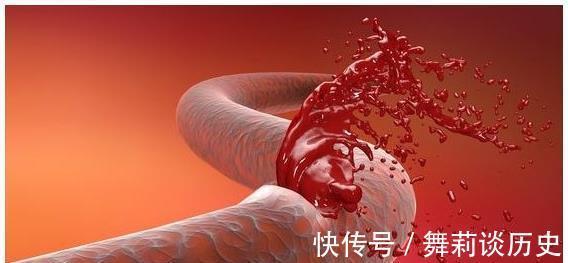 血压|“中风”为何越来越多？直言：改掉饭后3个习惯，脑血管会更健康