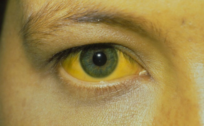 腹泻|一个部位长''小红点'',可能肝脏已''硬化如石'',最好早查肝CT