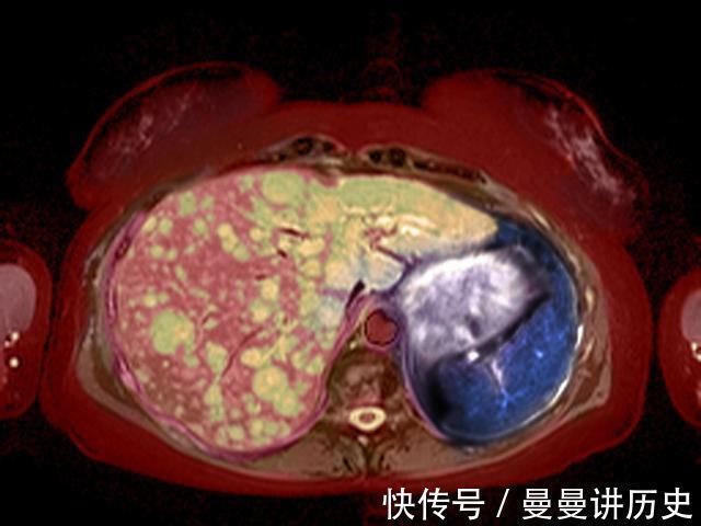 肝癌|23岁女大学生肝癌晚期,生命最后的愿望竟然是种一棵树