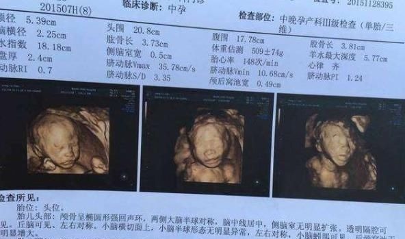 小美|不想生个“傻儿子”,孕期有三项检查不可少,准妈咪别不当回事