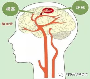 缺血性脑卒中|【静脉溶栓】静脉溶栓知多少？