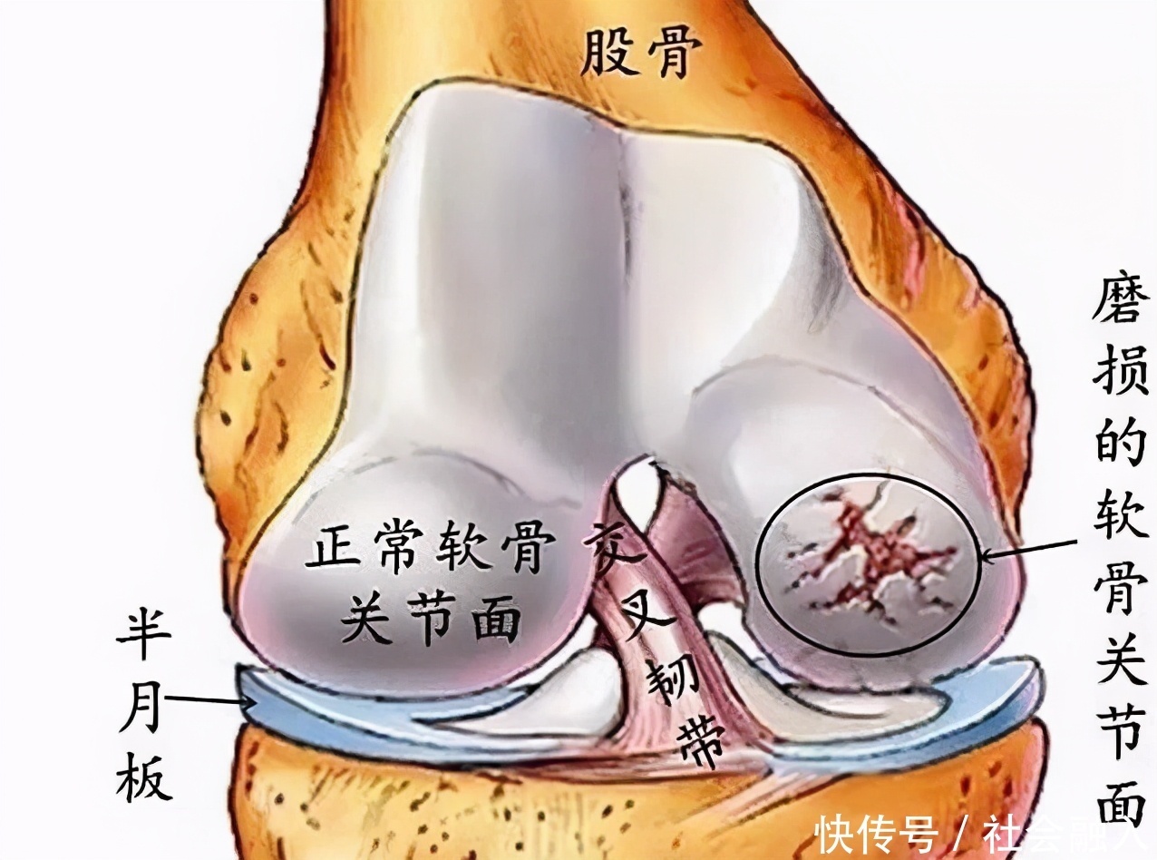 中老年人常受骨关节炎困扰，如何阶梯治疗减轻疼痛避免畸形