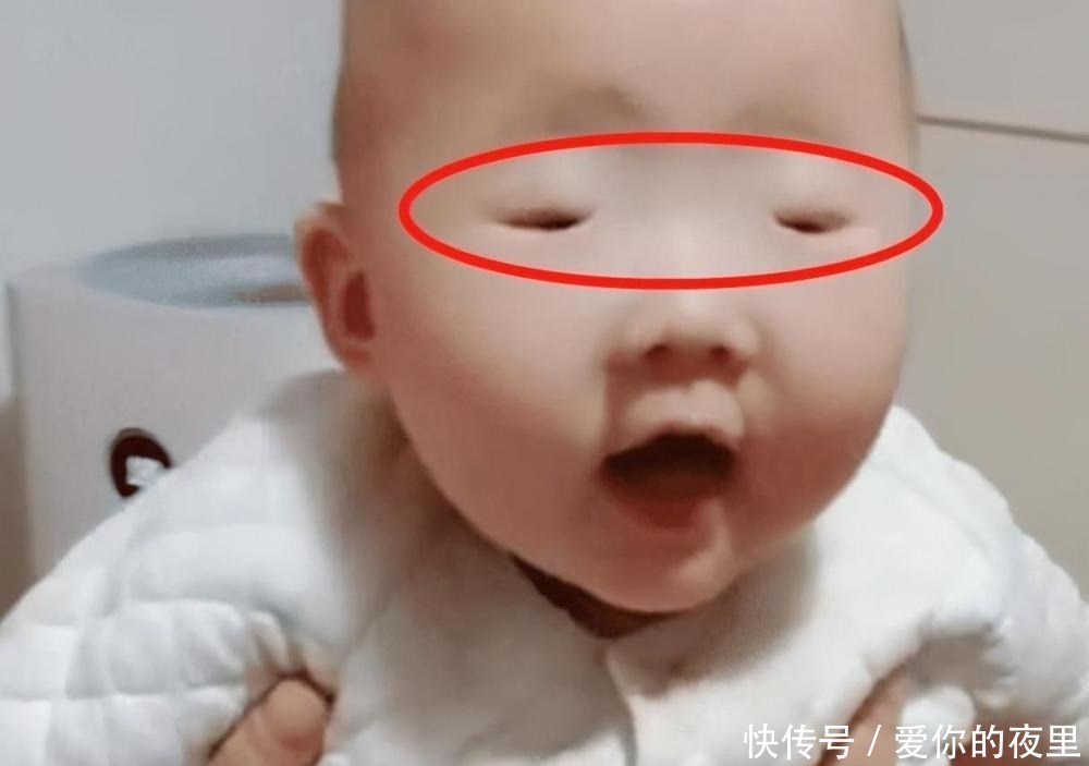宝宝|宝宝出生“豆豆眼”急坏妈妈，送医检查后医生却笑了：是你想多了