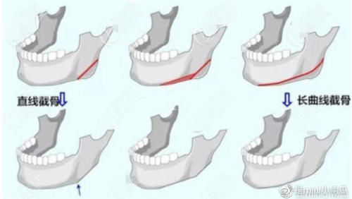 磨截联合长弧线下颌角整形比普通下颌角手术好在哪儿？风险更小吗？